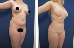 hd liposuction procedure - front right view