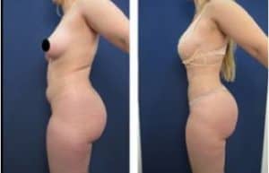 hd liposuction procedure - left view