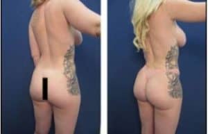 hd liposuction procedure with BBL - back right view