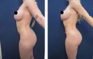 hd liposuction procedure with BBL - left view