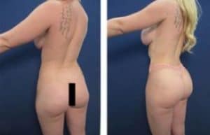 hd liposuction procedure with BBL - back left view