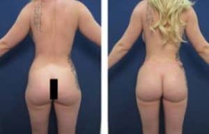 hd liposuction procedure with BBL - back view