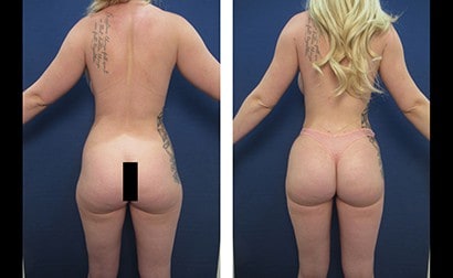 Female Thigh Gap Contouring
