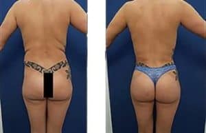 vaser hd liposuction with Brazilian Buttocks Lift and Renuvion skin tightening - back view