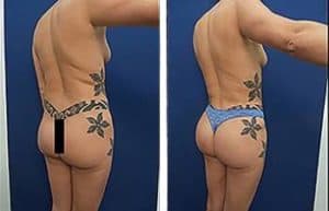 vaser hd liposuction with Brazilian Buttocks Lift and Renuvion skin tightening - back right view