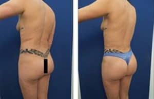 vaser hd liposuction with Brazilian Buttocks Lift and Renuvion skin tightening - back left view