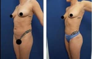 vaser hd liposuction with Brazilian Buttocks Lift and Renuvion skin tightening - left lateral view