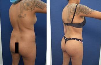 BBL with vaser hd liposuction procedure - back right view