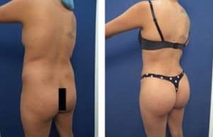 BBL with vaser hd liposuction procedure - back left view