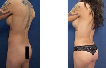 hd liposuction procedure - back left view