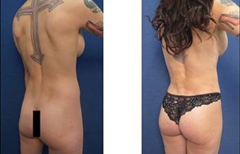 hd liposuction procedure - back right view