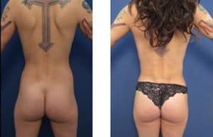 hd liposuction procedure - back view