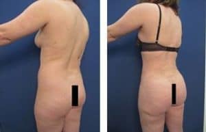 abdominal etching and hd liposuction procedure – back left view