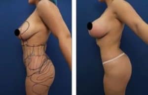 hd liposuction and bbl procedures - left view