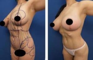 hd liposuction and bbl procedures - front left view