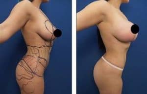 hd liposuction and bbl procedures - right view