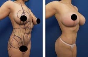 hd liposuction and bbl procedures - front right view