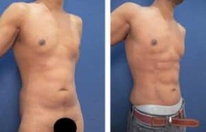 abdominal etching with hd vaser liposuction surgery result - right lateral view