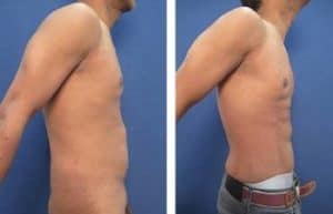 abdominal etching with hd vaser liposuction surgery result - right view