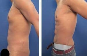 abdominal etching with hd vaser liposuction surgery result - left view