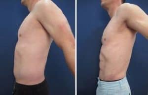 hd liposuction in men - left view