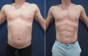 hd liposuction in men - front view