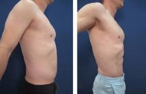 hd liposuction in men - right view