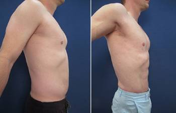 Patient 8284, Flank-Lower Back Liposuction, Male Liposuction Gallery