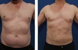 hd liposuction for men - front view