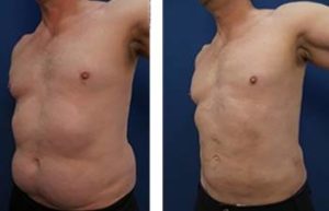 hd liposuction for men - left lateral view