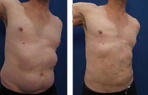 hd liposuction for men - front right view