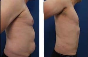 hd liposuction for men - right view