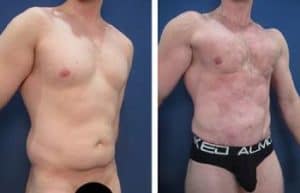 hd liposuction for men - right lateral view