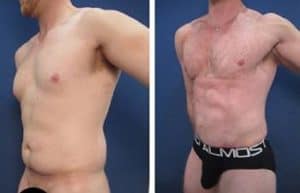 hd liposuction for men - left lateral view