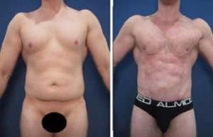 hd liposuction for men - front view