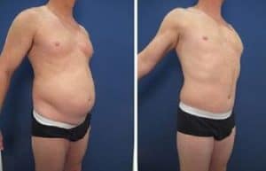 tummy tuck procedure with hd liposuction - right lateral view