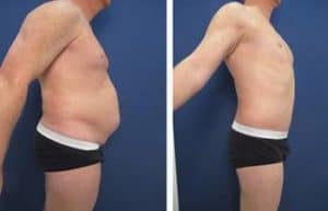 tummy tuck procedure with hd liposuction - right view