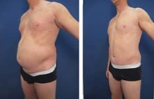 tummy tuck procedure with hd liposuction - front left view