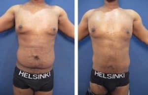 hd liposuction for men - front view