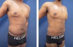 hd liposuction for men - right lateral view