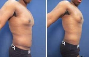 hd liposuction for men - right view