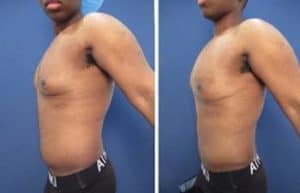 hd liposuction for men - left view