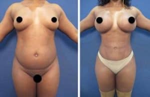 vaser hd liposuction procedure and breast augmentation - front view