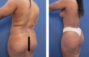 vaser hd liposuction procedure and breast augmentation - back left view