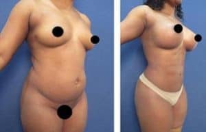 vaser hd liposuction procedure and breast augmentation - front right view