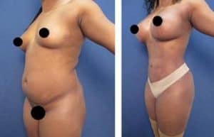 vaser hd liposuction procedure and breast augmentation - left lateral view