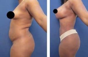 vaser hd liposuction procedure and breast augmentation - left view