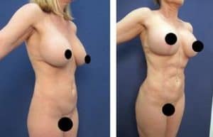 BBL with hd vaser liposuction procedure - front right view