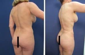 BBL with hd vaser liposuction procedure - back right view