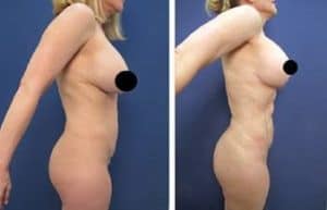 BBL with hd vaser liposuction procedure - right view